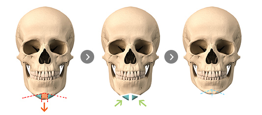 ㅅ-shaped osteotomy